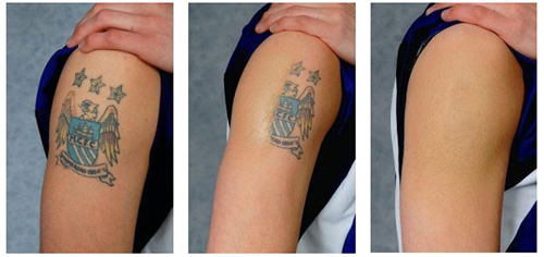 Linh kiện máy xóa xăm laser yag light spectra truoc va sau khi xoa 1.jpg (44 KB)